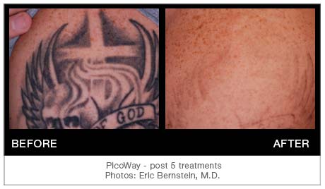 Tattoo Removal in Boise Idaho  All Colors  Spa 35 Med Spa  Boise ID   Spa 35